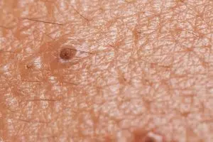 Blackhead