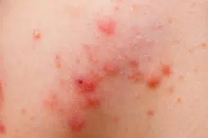 Cysts