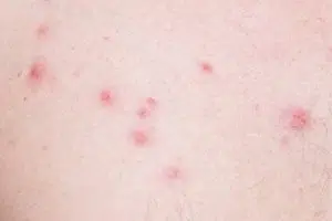 Nodule
