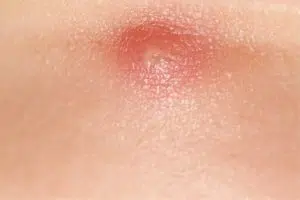 Papule