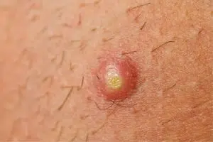 Pustule