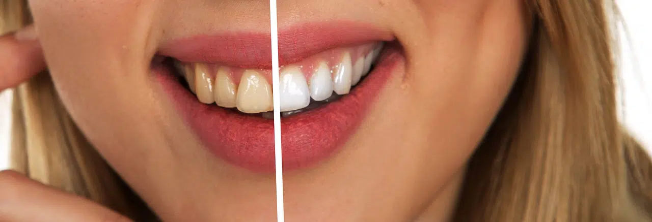 teeth cleaning