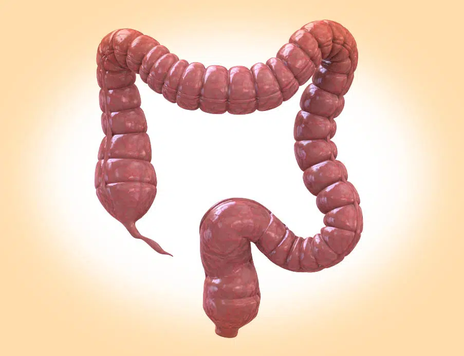 Diverticular disease