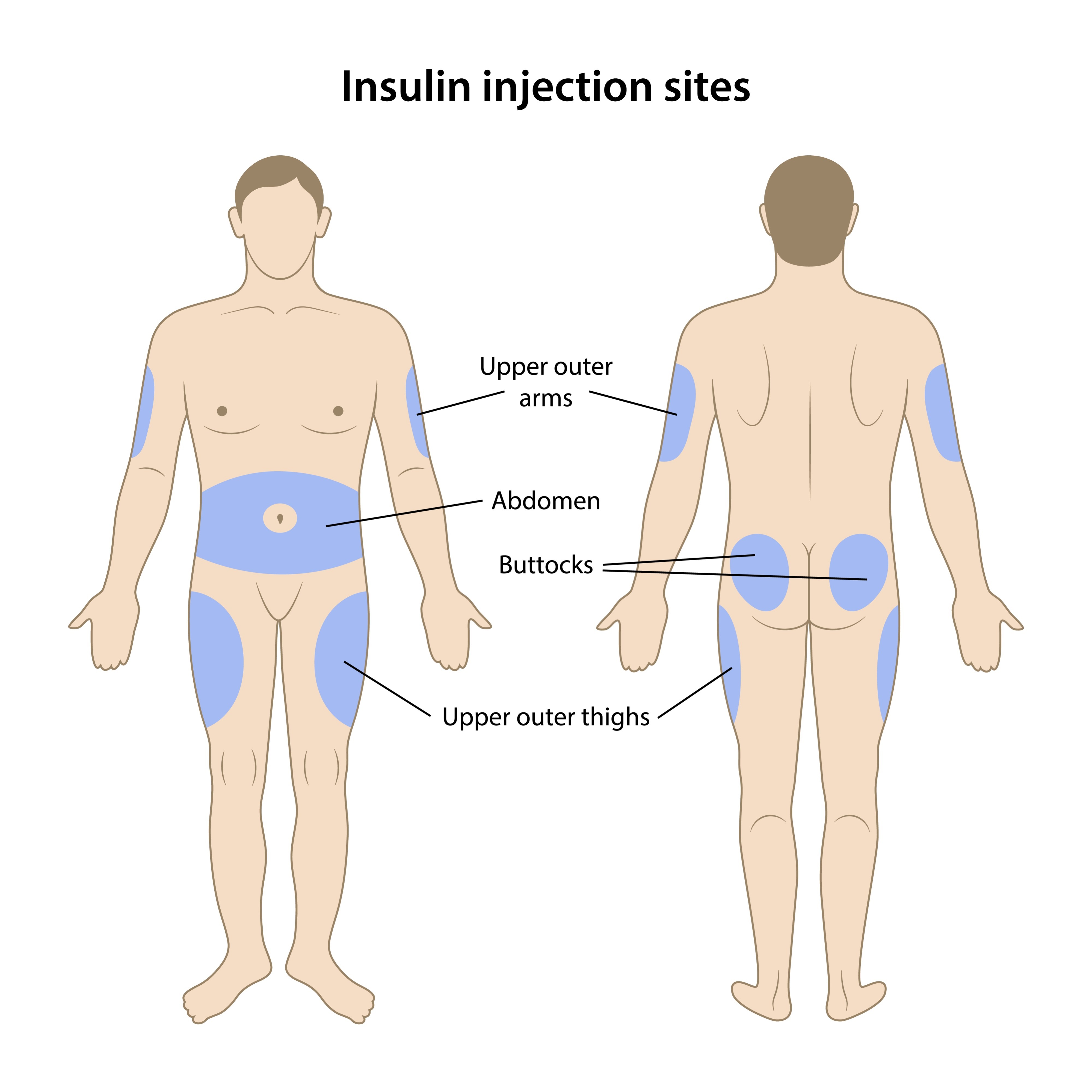 Image of insulin injection sites on the body