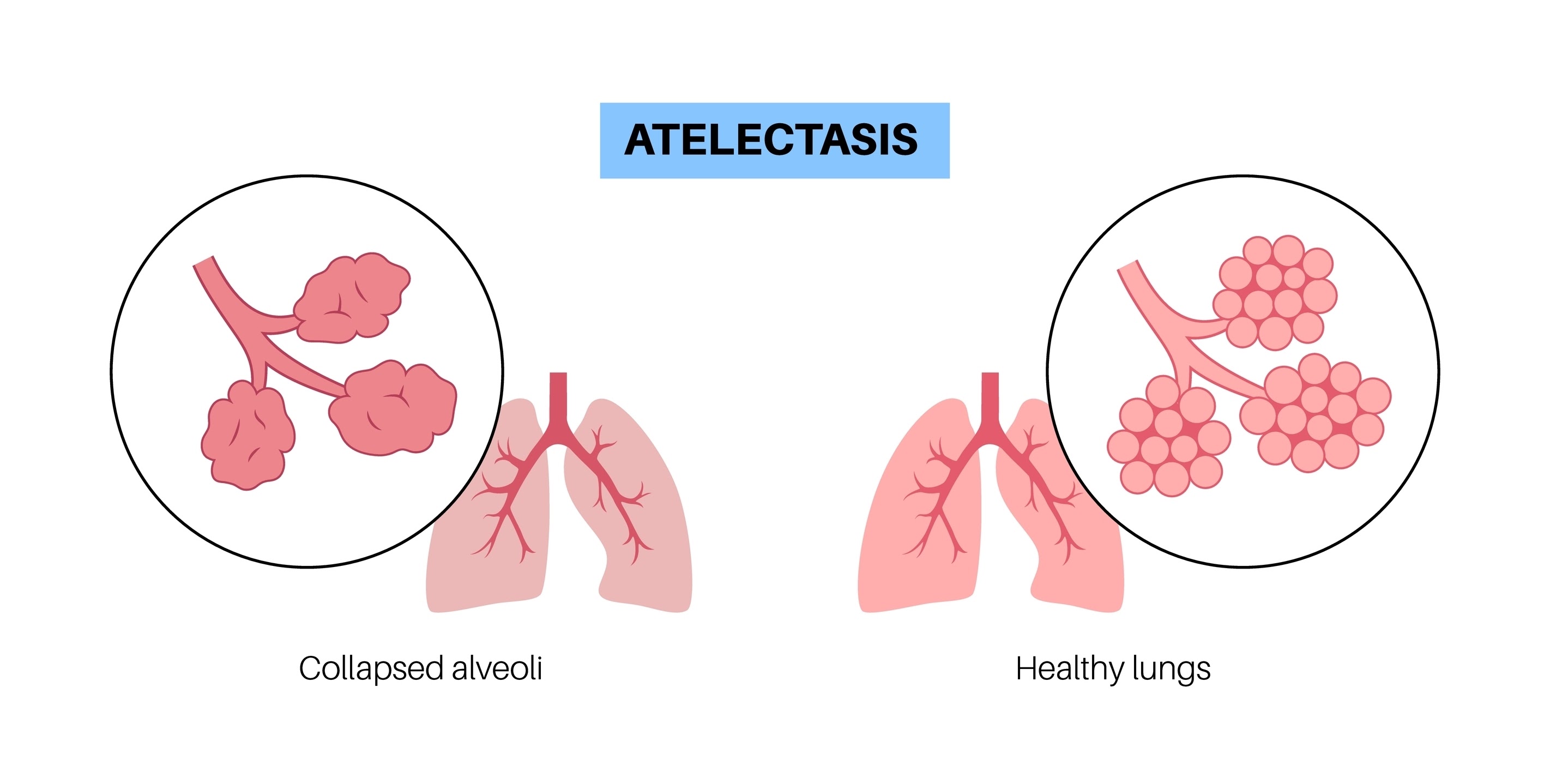 Image of healthy alveoli vs. collapsed alveoli (atelectasis)