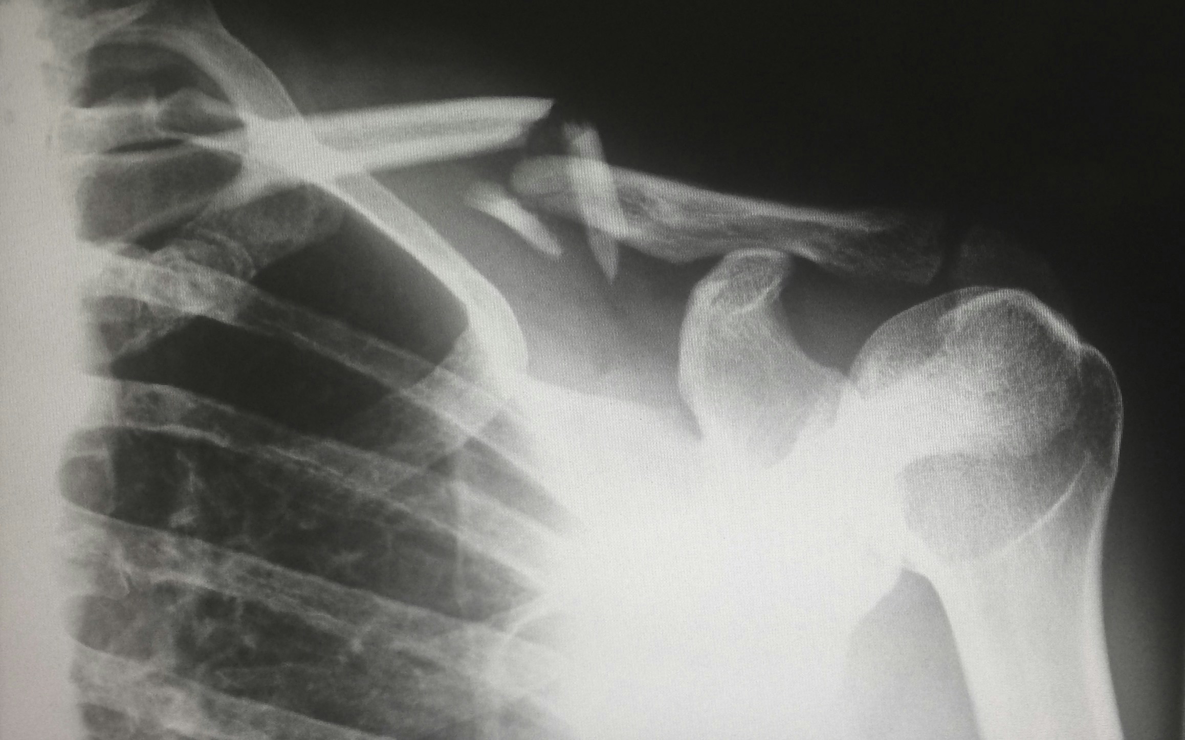 Serratus Anterior Pain